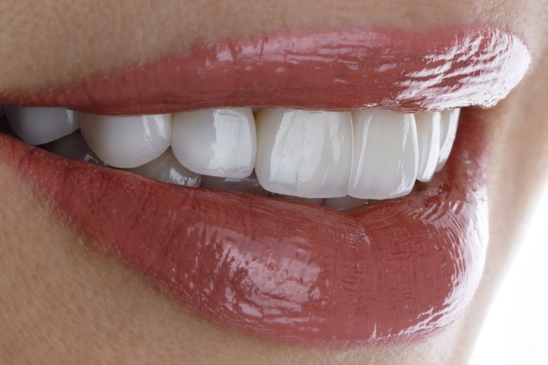 Full Porselen Diş Kaplaması Nedir Avantajları Nelerdir